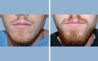 Before and After
